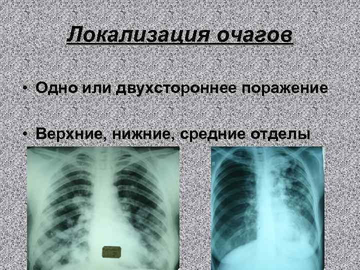 Локализация очагов • Одно или двухстороннее поражение • Верхние, нижние, средние отделы 