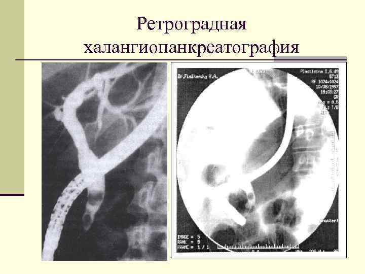 Ретроградная халангиопанкреатография 
