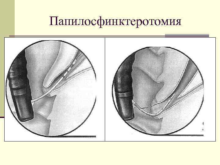 Папилосфинктеротомия 