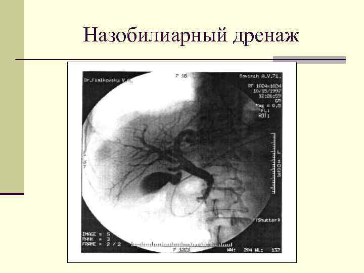 Назобилиарный дренаж 