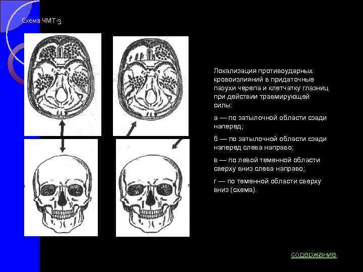Схема ЧМТ-3 Локализация противоударных кровоизлияний в придаточные пазухи черепа и клетчатку глазниц при действии