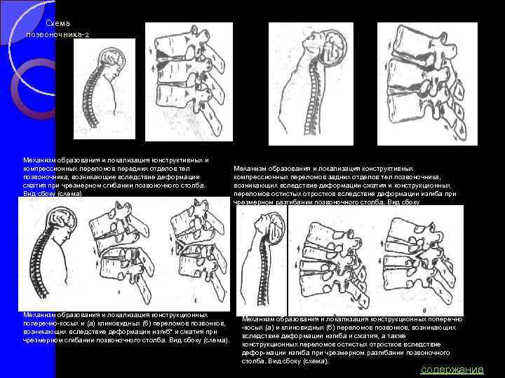 Схема позвоночника-2 Механизм образования и локализация конструктивных и компрессионных переломов передних отделов тел позвоночника,