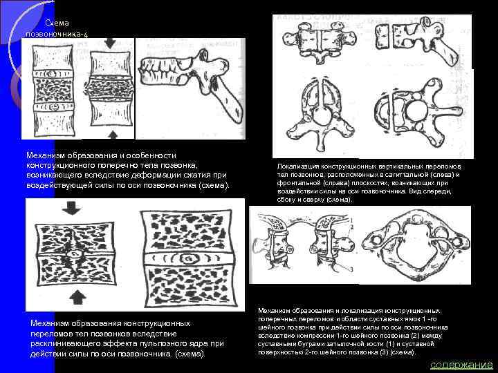Схема позвоночника-4 Механизм образования и особенности конструкционного поперечно тела позвонка, возникающего вследствие деформации сжатия