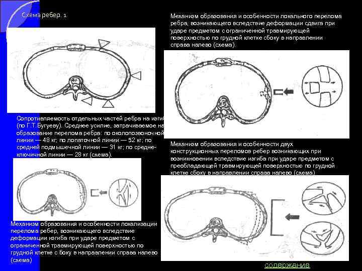 Схема ребер. 1 Механизм образования и особенности локального перелома ребра, возникающего вследствие деформации сдвига