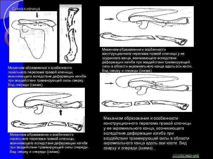 Схема ключица Механизм образования и особенности локального перелома правой ключицы, возникающего вследствие деформации изгиба