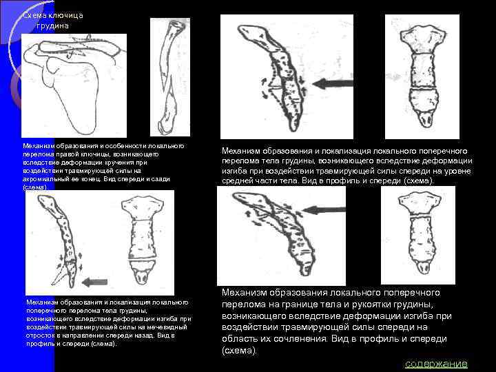 Перелом грудины презентация