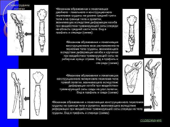 Схема грудины лопатки • Механизм образования и локализация двойного локального и конструкционного переломов грудины