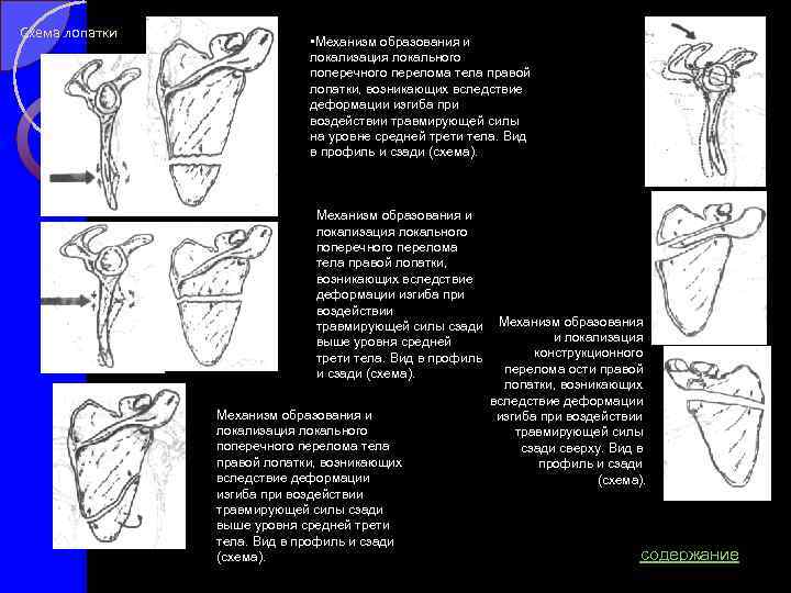 Схема лопатки • Механизм образования и локализация локального поперечного перелома тела правой лопатки, возникающих