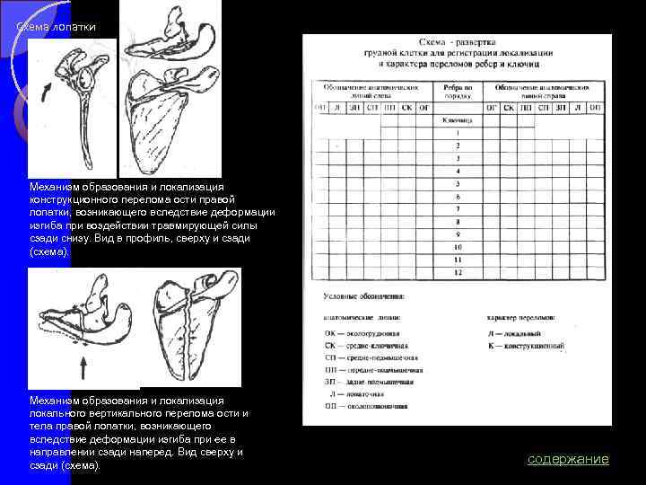 Схема лопатки Механизм образования и локализация конструкционного перелома ости правой лопатки, возникающего вследствие деформации