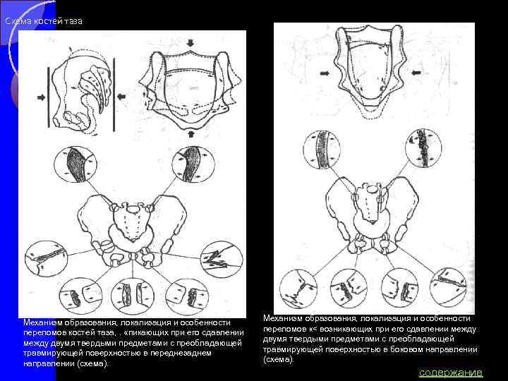 Повреждения таза травматология презентация