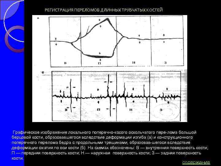 РЕГИСТРАЦИЯ ПЕРЕЛОМОВ ДЛИННЫХ ТРУБЧАТЫХ КОСТЕЙ Графическое изображение локального поперечно косого оскольчатого пере лома большой
