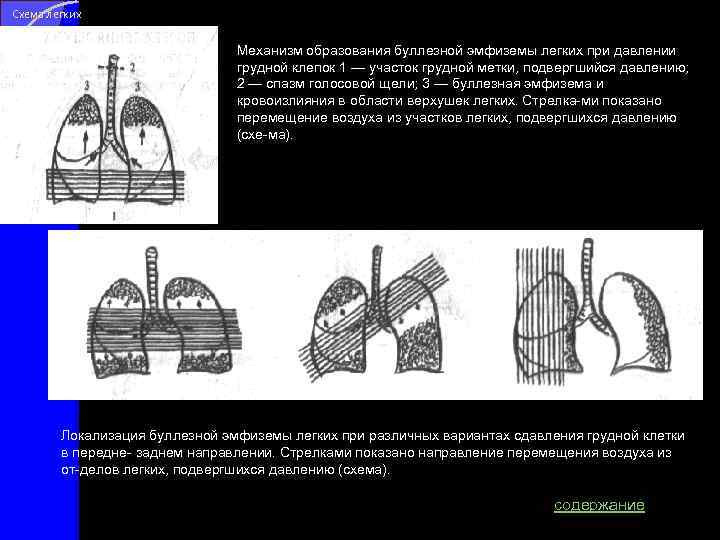 Схема легких Механизм образования буллезной эмфиземы легких при давлении грудной клепок 1 — участок