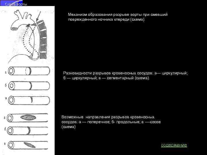 Схема аорты Механизм образования разрыве аорты при смевший поврежденного ночника кпереди (схема). Разновидности разрывов