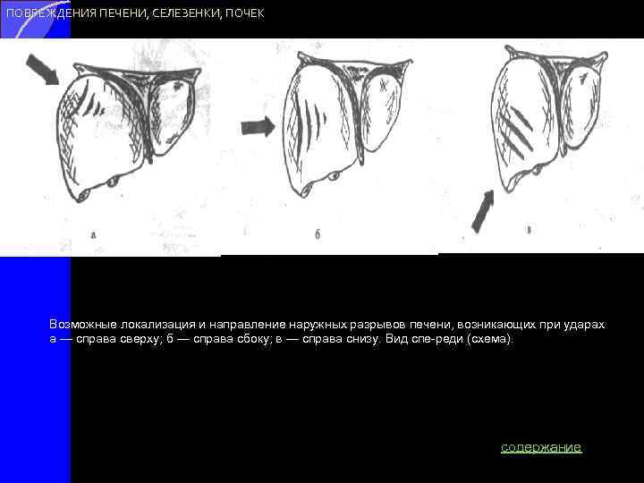 ПОВРЕЖДЕНИЯ ПЕЧЕНИ, СЕЛЕЗЕНКИ, ПОЧЕК Возможные локализация и направление наружных разрывов печени, возникающих при ударах