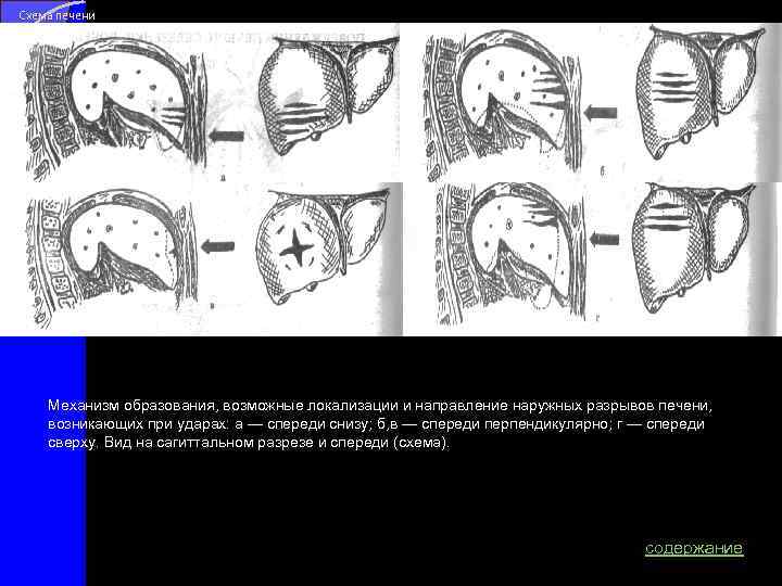 Схема печени б а в г Механизм образования, возможные локализации и направление наружных разрывов