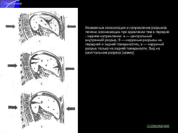 Схема печени Возможные локализация и направление разрывов печени, возникающих при сдавлении тем в передне