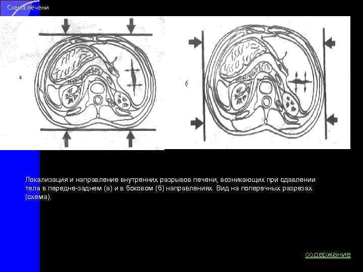 Схема печени Локализация и направление внутренних разрывов печени, возникающих при сдавлении тела в передне