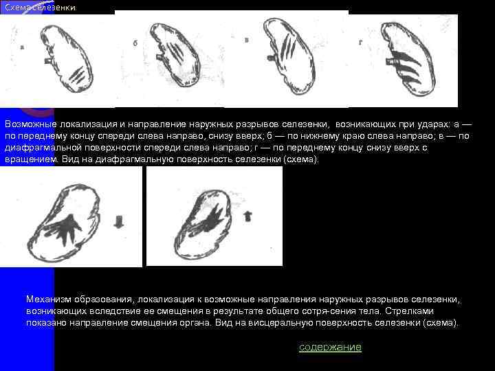 Схема селезенки Возможные локализация и направление наружных разрывов селезенки, возникающих при ударах: а —