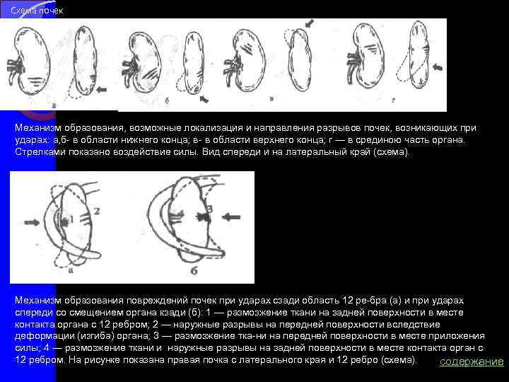 Схема почек Механизм образования, возможные локализация и направления разрывов почек, возникающих при ударах: а,