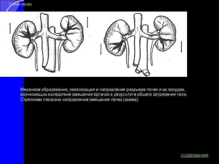 Схема почек Механизм образования, локализация и направления разрывов почек и их сосудов, возникающих вследствие