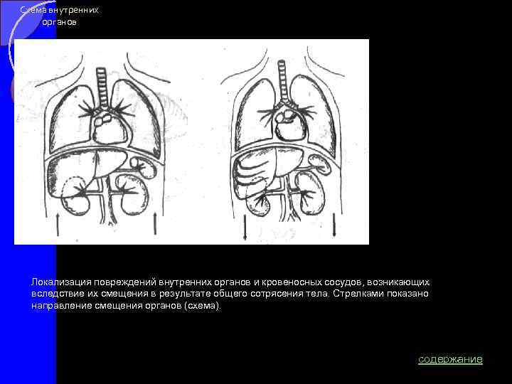 Схема внутренних органов Локализация повреждений внутренних органов и кровеносных сосудов, возникающих вследствие их смещения