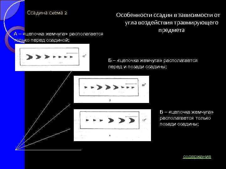 Ссадина схема 2 А – «цепочка жемчуга» располагается только перед ссадиной; Особенности ссадин в