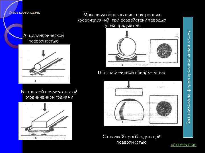 Механизм образования внутренних кровоизлияний при воздействии твердых тупых предметов: А цилиндрической поверхностью В с