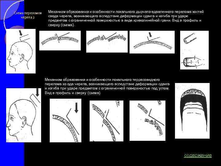 Схема переломов черепа 2 Механизм образования и особенности локального дырчато вдавленного перелома костей свода