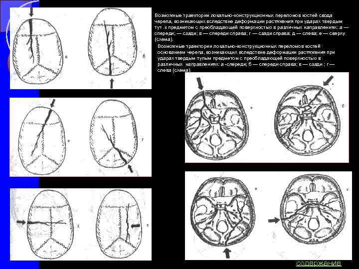 Схема переломов черепа 6 Возможные траектории локально конструкционных переломов костей свода черепа, возникающих вследствие