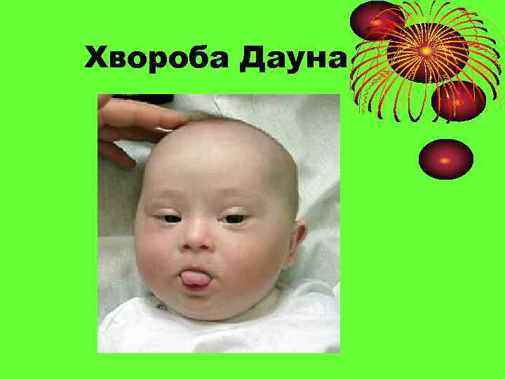 Хвороба Дауна 