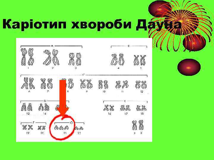 Каріотип хвороби Дауна 