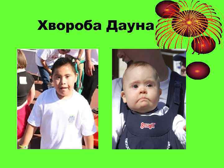 Хвороба Дауна 