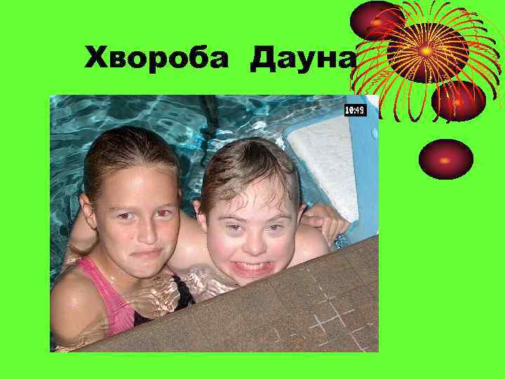 Хвороба Дауна 