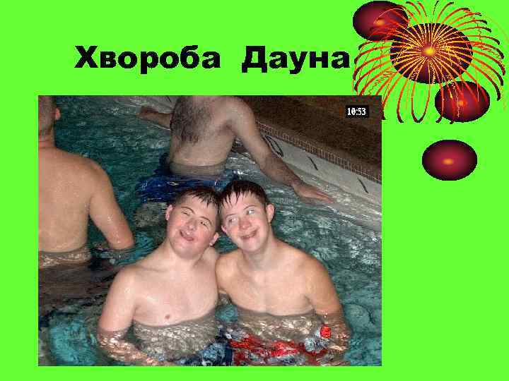 Хвороба Дауна 