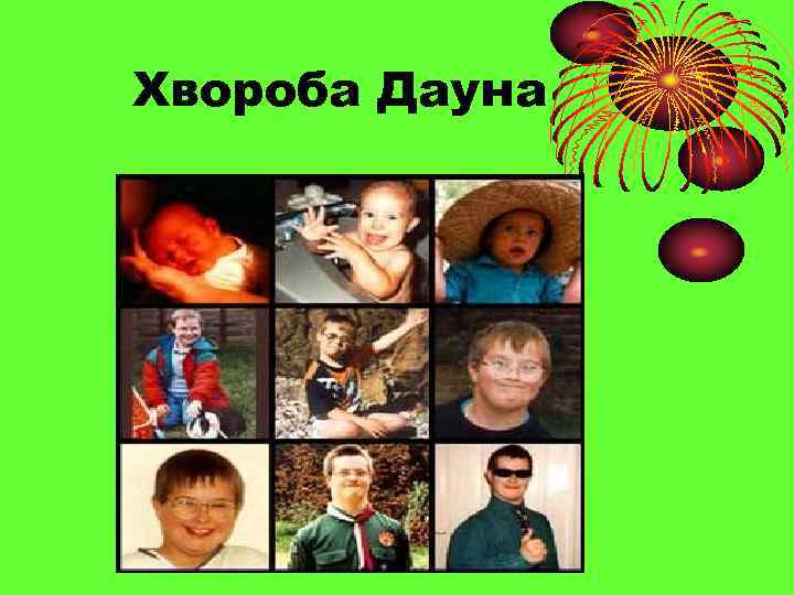 Хвороба Дауна 