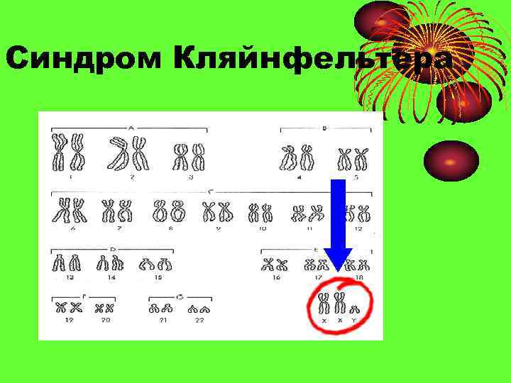 Синдром Кляйнфельтера 