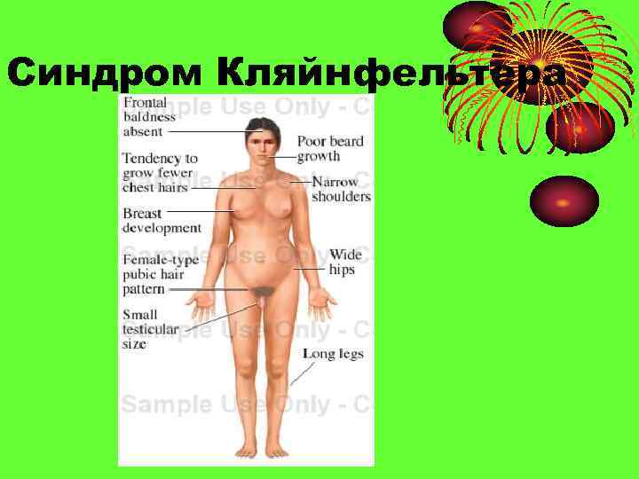 Синдром Кляйнфельтера 