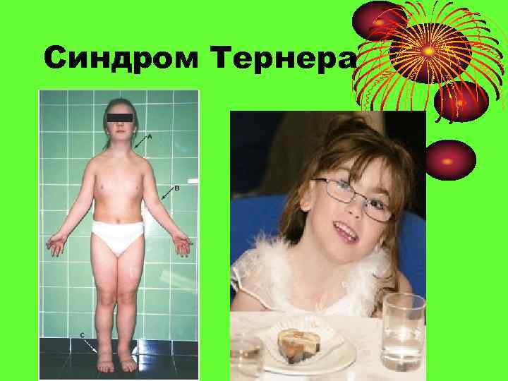 Синдром Тернера 
