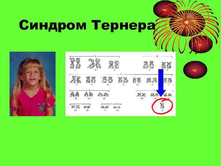 Синдром Тернера 