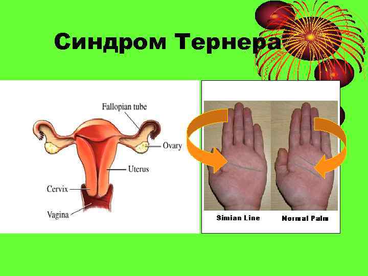 Синдром Тернера 