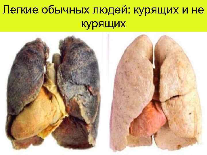 Легкие обычных людей: курящих и не курящих 