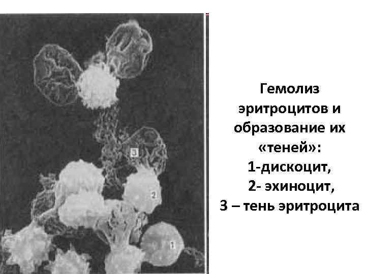 Гемолиз эритроцитов и образование их «теней» : 1 -дискоцит, 2 - эхиноцит, 3 –