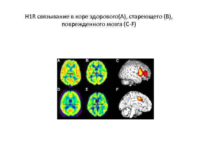 H 1 R связывание в коре здорового(А), стареющего (В), поврежденного мозга (С-F) 