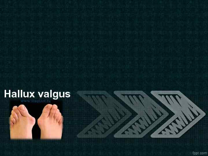 Hallux valgus 