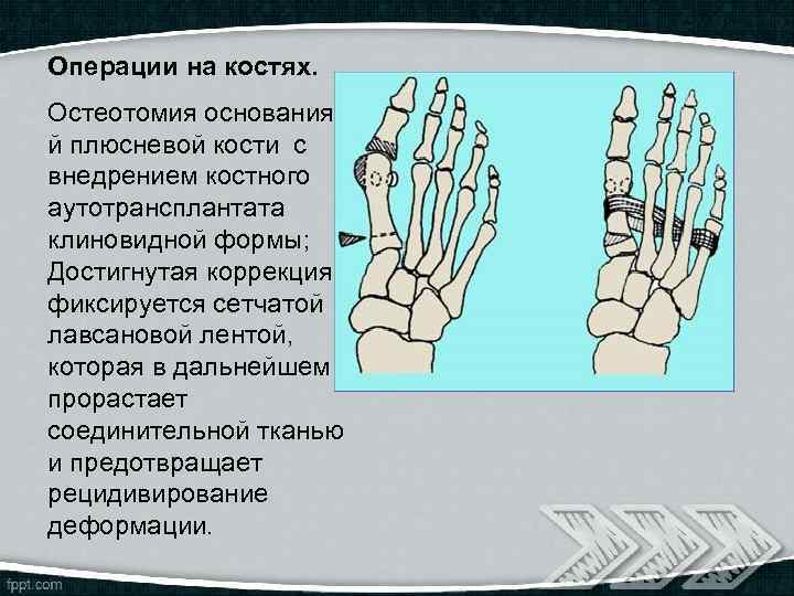 Операции на костях. Остеотомия основания 1 й плюсневой кости с внедрением костного аутотрансплантата клиновидной