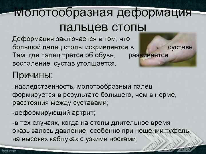 Молотообразная деформация пальцев стопы Деформация заключается в том, что большой палец стопы искривляется в
