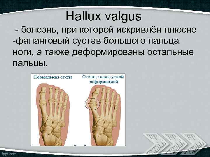 Hallux valgus - болезнь, при которой искривлён плюсне -фаланговый сустав большого пальца ноги, а