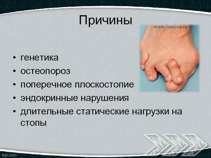 Причины • • • генетика остеопороз поперечное плоскостопие эндокринные нарушения длительные статические нагрузки на