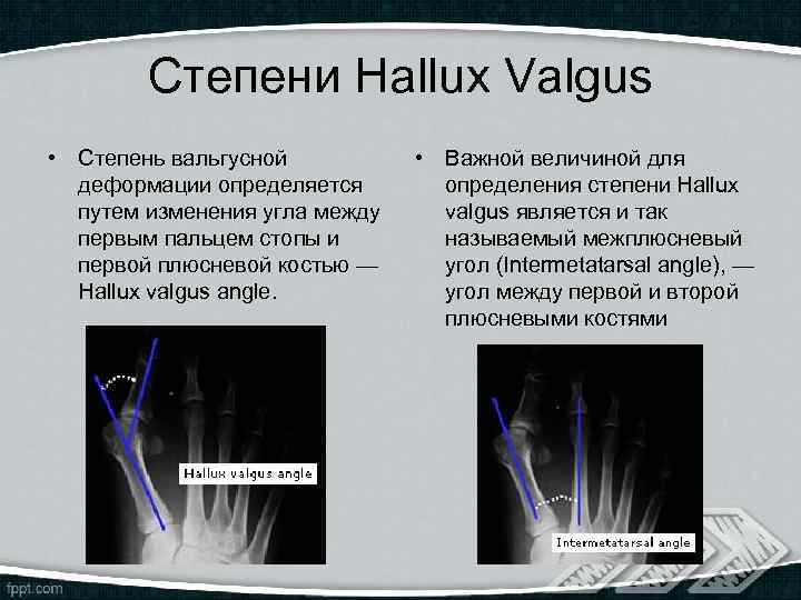 Степени Hallux Valgus • Степень вальгусной деформации определяется путем изменения угла между первым пальцем