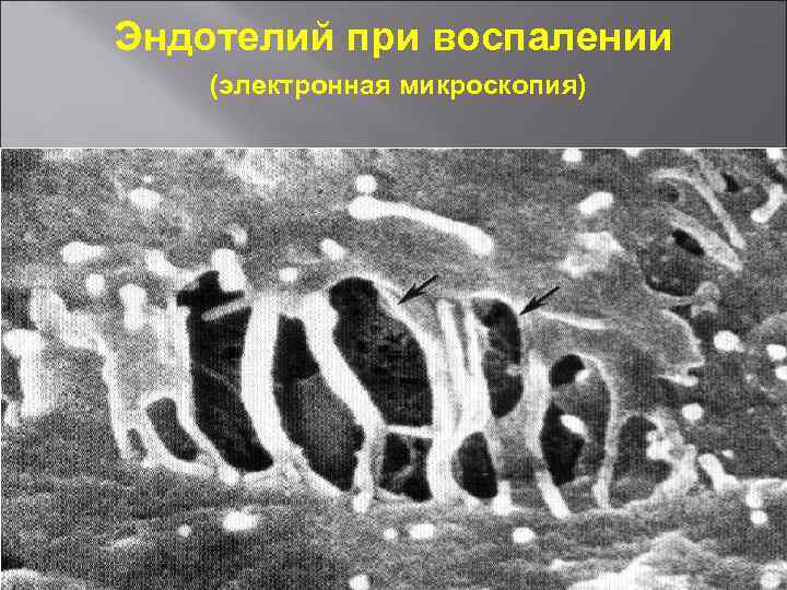 Эндотелий при воспалении (электронная микроскопия) 